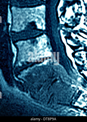 Magnetic Resonance Imaging (MRI) of Lumbar and Sacral Vertebrae (L4-5 ...