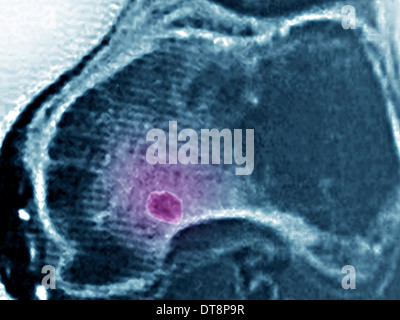 OSTEOID OSTEOMA MRI Stock Photo