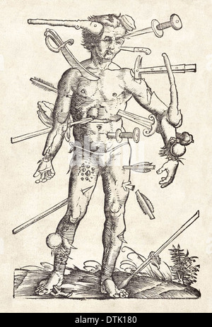 Wound Man woodcut attributed to Hans Wechtlin from German surgeon Hans von Gersdorff’s Field book of surgery published in 1517. Stock Photo