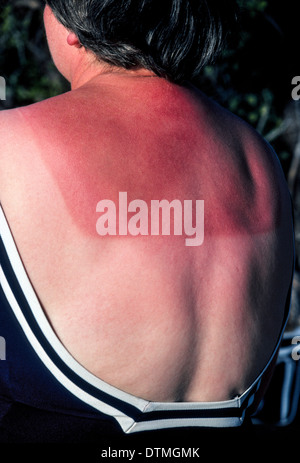 The skin on the back of a Caucasian woman shows sunburn damage when she was wearing a low-cut blouse prior to putting on this backless bathing suit. Stock Photo