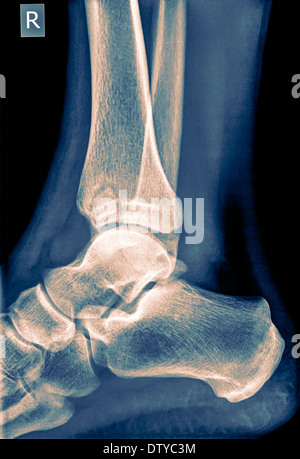 X-ray of an ankle 50 year old male with a fractured tibia. Side View Stock Photo