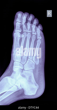 x-ray of a foot showing a fracture in the 5th metatarsalia of a 31 year old male Stock Photo