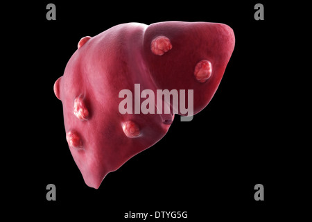 Liver Cancer Stock Photo