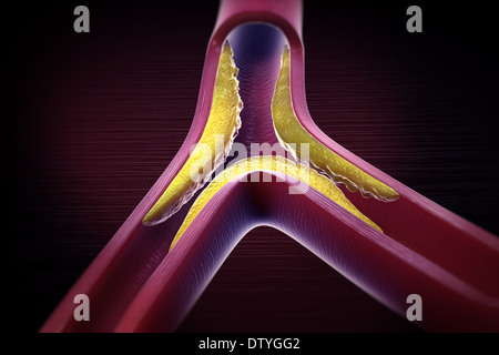 Atherosclerosis Stock Photo Alamy