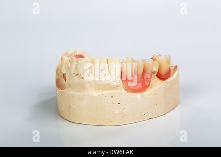 A partial denture mounted on a plaster study model and placed on a shiny gray background Stock Photo