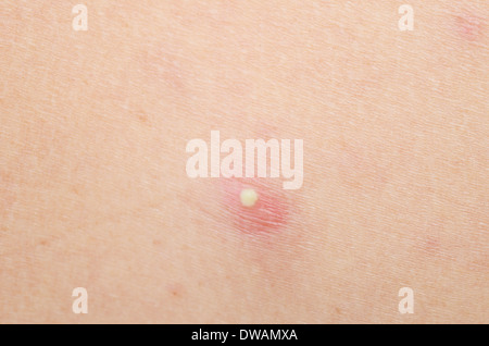 pimple on human skin Stock Photo