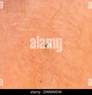 Bee Sting Stuck In Human Skin Stock Photo