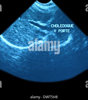 common hepatic duct ultrasound