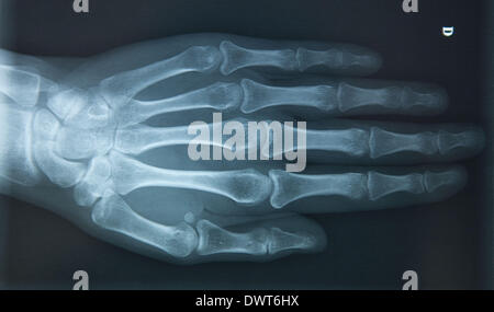 wrist and hand x-ray of a 4 year old infant male with a Distal radius ...