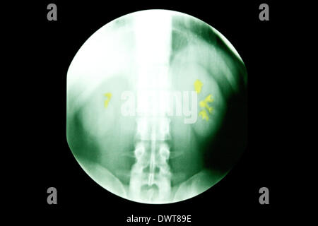 Kidney ultrasound scan Stock Photo