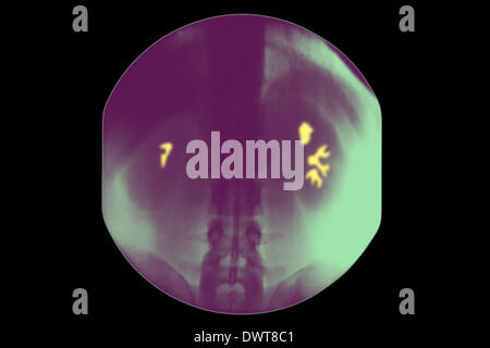 Kidney ultrasound scan Stock Photo