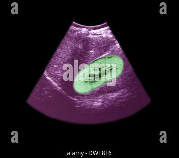 Kidney ultrasound scan Stock Photo