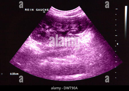 Kidney ultrasound scan Stock Photo