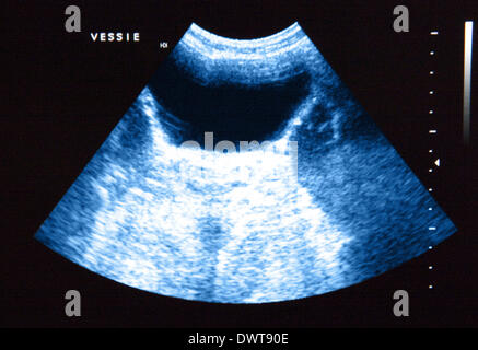 Bladder ultrasound scan Stock Photo - Alamy