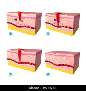 WOUND HEALING, ILLUSTRATION Stock Photo: 75741158 - Alamy