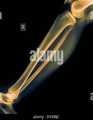 X-ray of lower leg of 50 year old male with fractured tibia front view Stock Photo