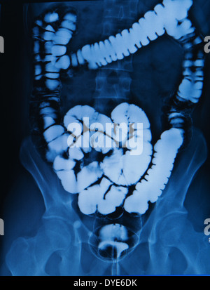 barium enema of a man demonstrated the normal cecum Stock Photo