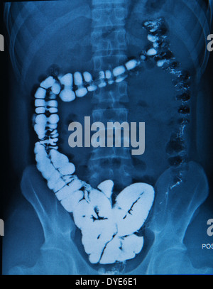 barium enema of a man demonstrated the normal cecum Stock Photo