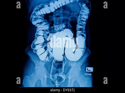 barium enema of a man demonstrated the normal rectum and cecum Stock Photo