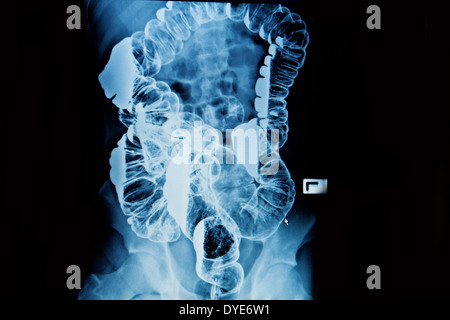 barium enema of a man demonstrated the normal rectum and cecum Stock Photo