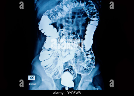 barium enema of a man demonstrated the normal rectum and cecum Stock Photo