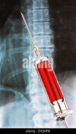 Injektionsnadel und Spritze vor einem Rˆntgenbild / Needle and syringe in front of an x-ray, Spritze vor Roentgenaufnahme Stock Photo