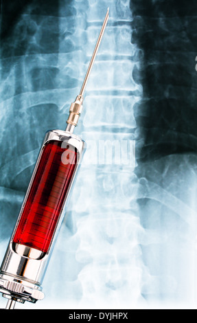 Injektionsnadel und Spritze vor einem Rˆntgenbild / Needle and syringe in front of an x-ray, Spritze vor Roentgenaufnahme Stock Photo