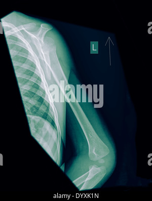 X-ray of a Human forearm with fat pad signs and a Supracondylar humerus fracture on the left arm of a 3 year old male infant Stock Photo