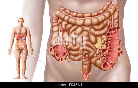 Diverticulitis in the descending colon region of the human intestine. Stock Photo