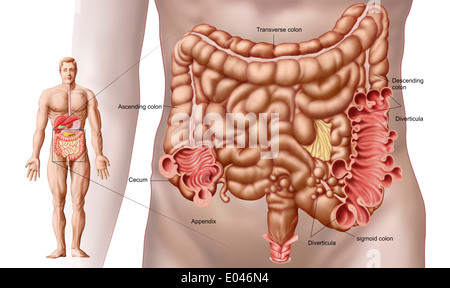 Diverticulitis in the descending colon region of the human intestine Stock Photo