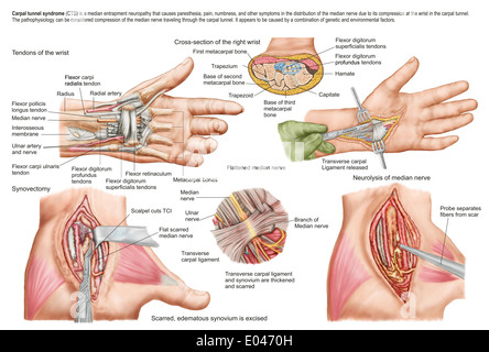 Medical illustration showing carpal tunnel syndrome in the human wrist, and the surgical procedures associated with it. Stock Photo