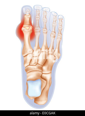 Gout, drawing Stock Photo