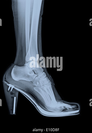 X-Ray of a foot and ankle in a high heel shoe Stock Photo