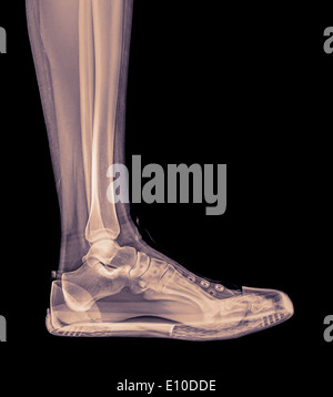X-Ray of a foot and ankle in a trainer Stock Photo