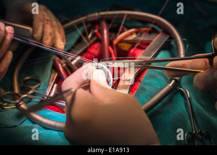 suture valve ring in mitral valve repair operation Stock Photo