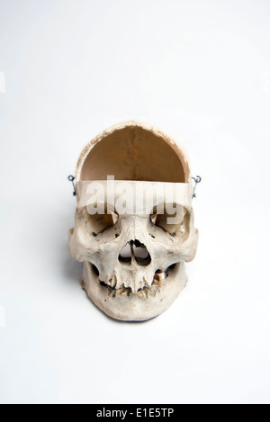 Genuine Human Skull with trephination and front quarter removed used for Medical Studies Stock Photo