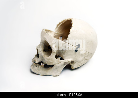 Genuine Human Skull with trephination and front quarter removed used for Medical Studies Stock Photo