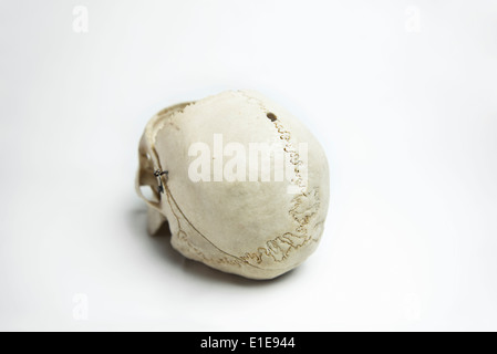 Genuine Human Skull with trepidation and front quarter removed used for Medical Studies Stock Photo