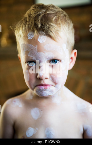 A five year old boy being treated with Calamine Lotion for chicken pox - Varicella zoster virus. Stock Photo