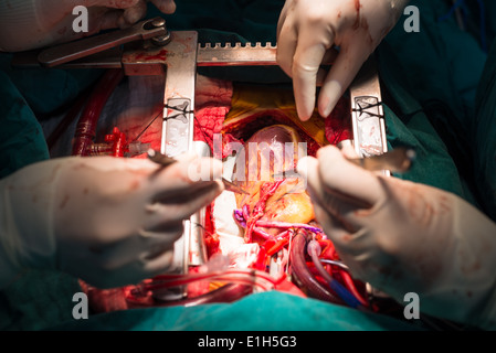 coronary artery bypass grafting Stock Photo