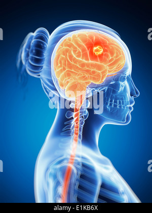 Female brain showing tumour computer artwork. Stock Photo