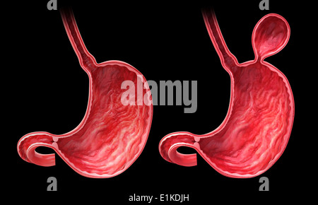 Human stomach with hernia cut-away computer artwork. Stock Photo