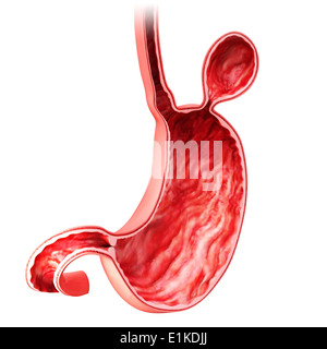 Human stomach with hernia cut-away computer artwork. Stock Photo