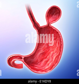 Human stomach with hernia cut-away computer artwork. Stock Photo