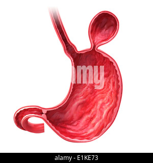 Human stomach with hernia cut-away computer artwork. Stock Photo