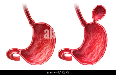 Human stomach with hernia cut-away computer artwork. Stock Photo