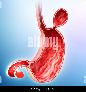 Human stomach with hernia cut-away computer artwork. Stock Photo