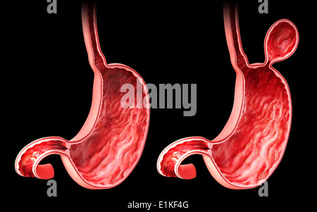 Human stomach with hernia cut-away computer artwork. Stock Photo