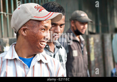 Face of badly burned man smiling in Kathmandu, Nepal Stock Photo