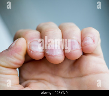 Close up of bitten fingernails Stock Photo